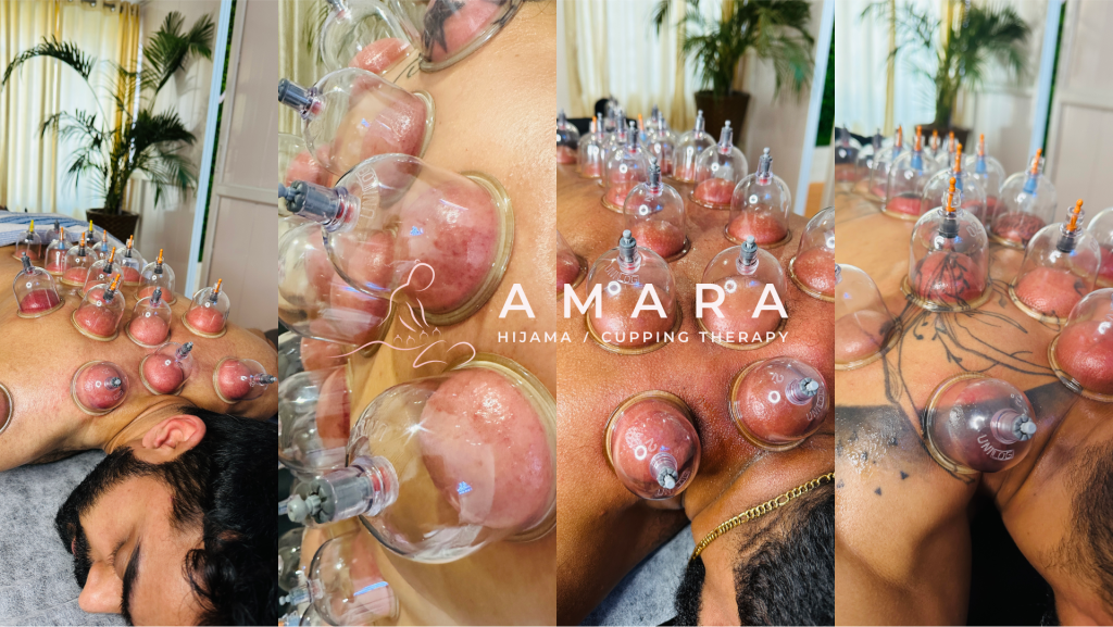Cupping Therapy in mangalore at Amara Cupping